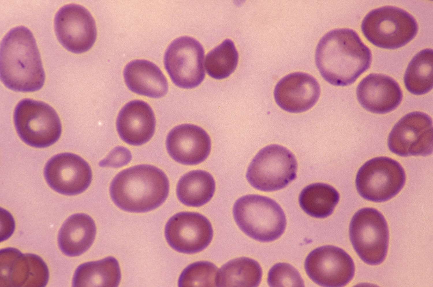 Shingles Reactivation: Causes, Signs, and Immunity