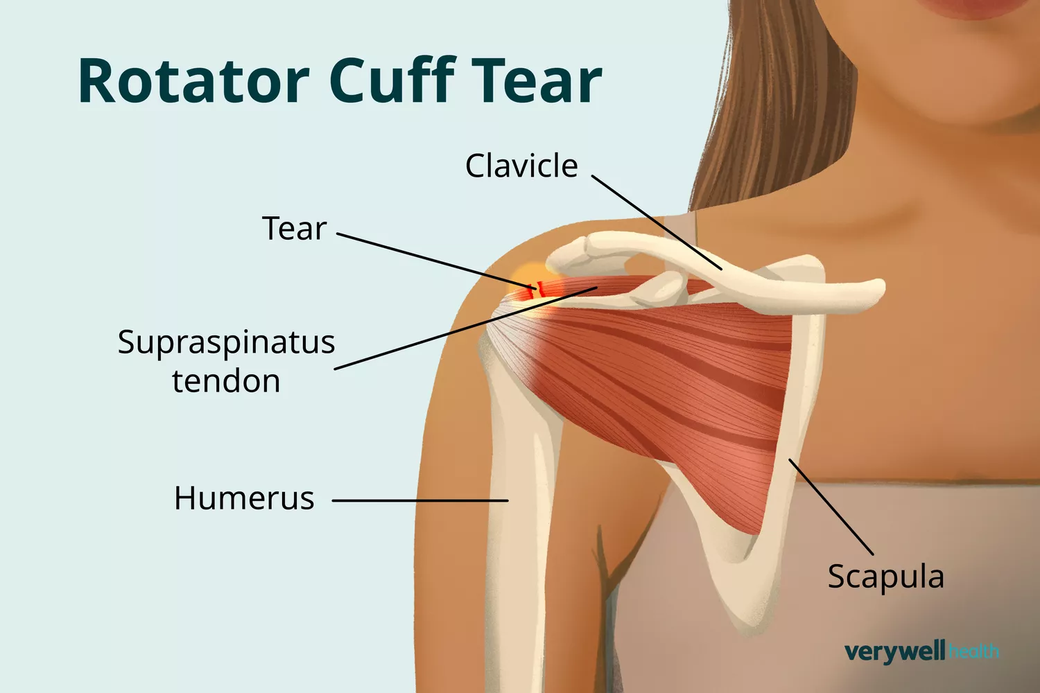 Medical illustration highlighting a rotator cuff tear within the shoulder joint anatomy.