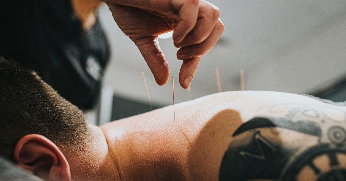 Close-up of a sterile acupuncture needle being applied to a patient's skin by a licensed professional.
