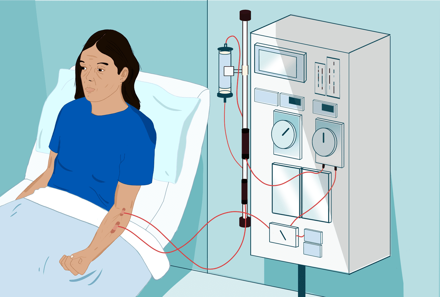 Dialysis Treatment Guide: Navigating ESRD Options