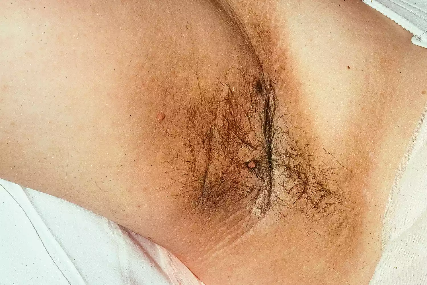 Close-up of skin texture and pigmentation for dermatological reference.