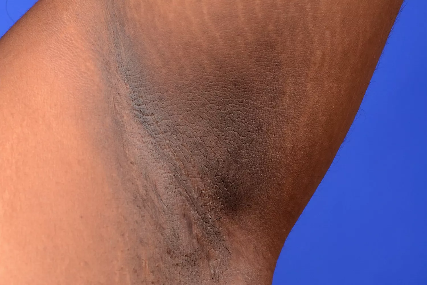 Medical photograph of Acanthosis nigricans showing hyperpigmentation in skin folds.